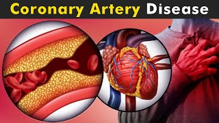 How Coronary Artery Disease Work  Symptoms Causes And Treatment UrduHindi [upl. by Krisha294]