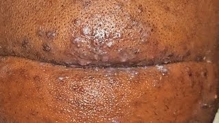 Satisfying Ingrown Hair Removal  Inflamed Infected Whiteheads back of head  Pt 1 [upl. by Toshiko225]