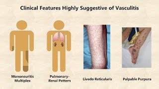 Vasculitis  An Overview [upl. by Leinadnhoj]