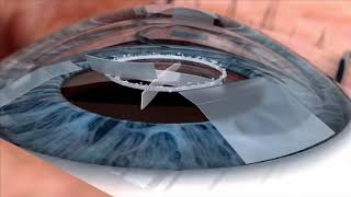 Watch live surgery using the laser cataract system  how does it work Eye News TV [upl. by Nysila]