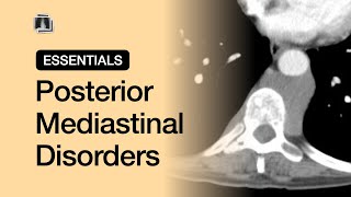 Posterior Mediastinal Disorders  Chest Radiology Essentials [upl. by Afira]