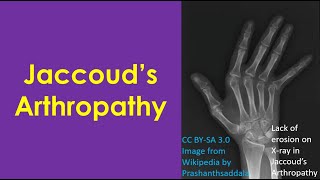 Jaccoud’s Arthropathy [upl. by Denie605]