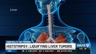 YOUR HEALTH Histotripsy Liquifying liver tumors [upl. by Snashall]