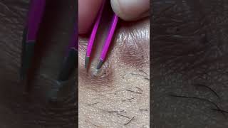 Ingrown hair removal [upl. by Nilrak]