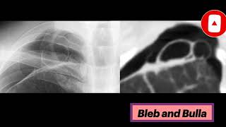 Blebs and Bullae radiology thoracicsurgery pulmonology [upl. by Stephan387]