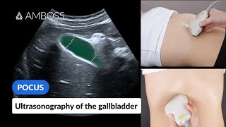 Point of Care Ultrasound of the Gallbladder  AMBOSS Video [upl. by Goldarina]