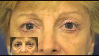 Blefaroplastia antes y después Dr M Devoto buenos Aires [upl. by Bronez60]