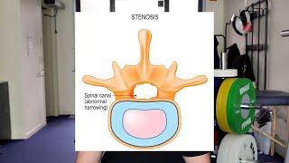 Still Have Sciatica  Foot Tingle after Disc Bulge Operation [upl. by Dettmer]