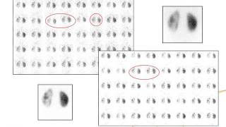 IAEAESNM Webinar  Cortical static renal scintigraphy and radionuclide cystographies [upl. by Nahgaem]