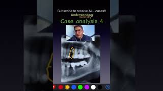 Can you find all alterations Case 4  Dental Quiz dentalstudents dentalimage [upl. by Devora]