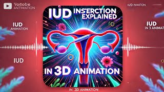 IUD INSERTION EXPLAINED IN 3D ANIMATION [upl. by Yonina300]