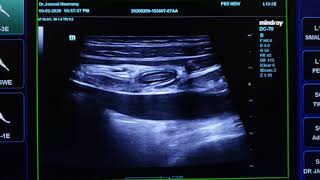 Mesenteric Lymphadenitis Ultrasound [upl. by Bray]