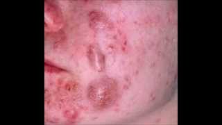 What is cystic acne How to treat cystic acne Answers [upl. by Lekram]