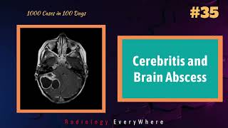 Brain Abscesses Cerebritis Causes and Radiological findings  1000 cases in 100 days  video 35 [upl. by Ahgiela]