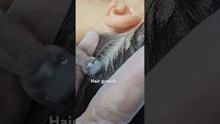 Scalp Microneedling Hair growth benefitsscalp scalpcare scalpmicroneedling scalptreatment hair [upl. by Myke150]