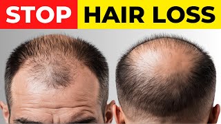 5 Powerful Vitamins That Prevent Hair Loss [upl. by Fiester799]