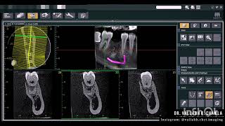 CONDENSING OSTEITIS  OPG vs CBCT 2D vs 3D IMAGING MODALITY [upl. by Lianne]