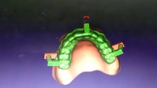 exocad denture module with jig [upl. by Lenhard987]