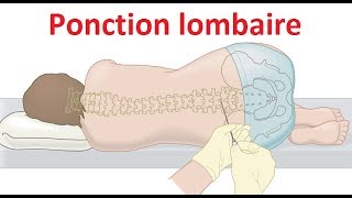 Ponction lombaire Examen du liquide céphalorachidien LCR [upl. by Yreffeg]