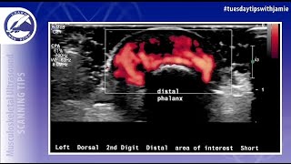 6 Characteristics of a Glomus Tumor of the Hand on MSK Ultrasound [upl. by Eelannej]