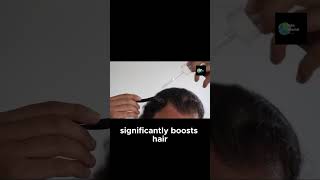 Micro Needling The Secret to Hair Regrowth [upl. by Aillij178]