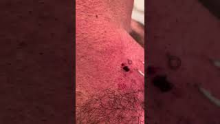 Monster ingrown hair finally out after 10 years [upl. by Ultann]