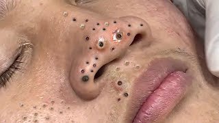 Big Cystic Acne Blackheads Extraction Blackheads amp Milia Whiteheads Removal Pimple Popping  1221 [upl. by Aleron]