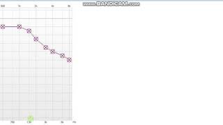 Presbycusis Hearing Loss Audiogram [upl. by Jenness]