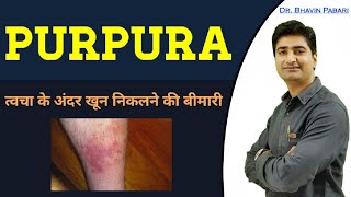 WHAT IS PURPURA BLEEDING DISORDER  TYPES  CAUSES  PURPURA IN HINDI [upl. by Yarised438]