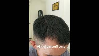 Day 30 Of Minoxidil Treatment  Without Finasteride [upl. by Adilen]