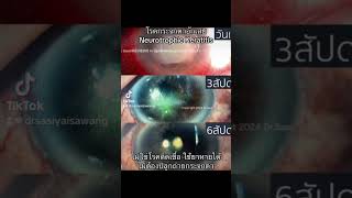 neurotrophic keratitis [upl. by Meredith]