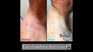 Eosinophilic Folliculitis [upl. by Niamert]