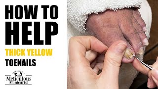 How to Help Thick Yellow Toenails at Home [upl. by Llehcal848]