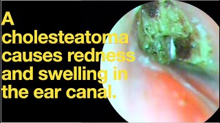 A cholesteatoma causes redness and swelling in the ear canalear wax removal  ear cleaning  ASMR [upl. by Mae]