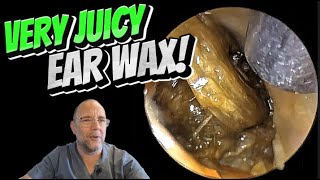 VERY JUICY EAR WAX 290 ear earwax earwaxremoval earcleaning fyp asmr foryou satisfying [upl. by Aerdnwahs]