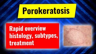 Porokeratosis overview clinical subtypes histology treatment options Dermatology review series [upl. by Warton]