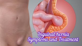 Inguinal hernia I Symptoms and Treatment I हर्निया क्या है DrAshishSachan [upl. by Eiramlirpa]