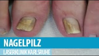 Nagelpilz Onychomykose mit dem Laser behandeln [upl. by Naaman]