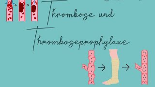 Thromboseprophylaxe Examensfrage [upl. by Suirada]