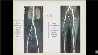 Capsule 9 Obliterative arteriopathy of the lower limbs  Dr Zaki Khadija [upl. by Ettelliw]