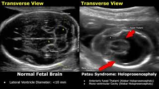 Fetal Ultrasound Normal Vs Patau Syndrome Imaging Findings  Holoprosencephaly amp Other Abnormalities [upl. by Leiso]