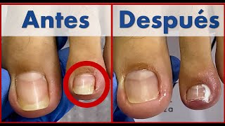 pedicura profunda  que uso para desinfectar y cicatrizar trabajo en cliente  Extreme pedicure [upl. by Malvie479]