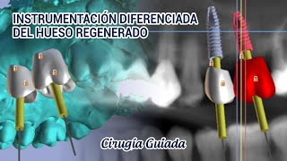 CIRUGIA GUIADA Instrumentación diferenciada del hueso regenerado [upl. by Wincer]