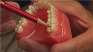 Tooth amp Gum Abscesses  How Dentists Drain an Abscessed Tooth [upl. by Dobbins]