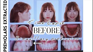 Braces Time Lapse 2 years 8 months⎥4 Premolars Extracted Bimaxillary Protrusion Side Profile [upl. by Aehsal]