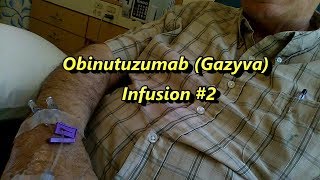 Second Full Infusion of Obinutuzumab Gazyva [upl. by Nnylesor611]