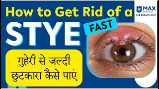 Home Remedies for Eye Stye in Hindi Simple Tips for Quick Relief from Eye Infection [upl. by Riamu]