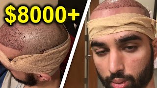 I GOT MY HAIR TRANSPLANT AT AGE 21 8000 [upl. by Eseilanna]