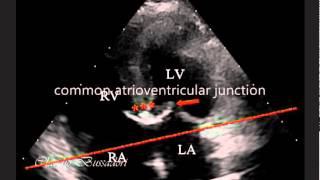 PARTIAL ATRIOVENTRICULAR CANAL WITH OSTIUM SECUNDUM ATRIAL SEPTAL DEFECT IN A DOG [upl. by Crawford]