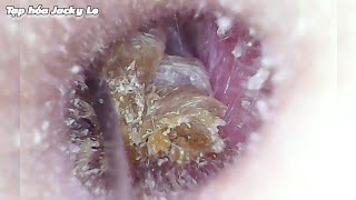 Ear Wax Removal 117 Please My Earwax Is So Itchy That I Cant Sleep  Ear Cleaning ASMR [upl. by Fink854]